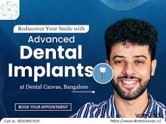 Dental Implants in Bangalore | Affordable Implant Solutions
