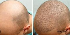 Best Hair Transplant in Nashik | Dr. Pranay Thakur